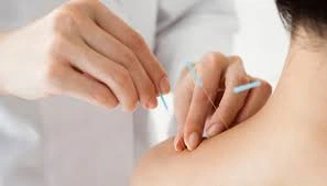 Acupuntura para ansiedade e stress